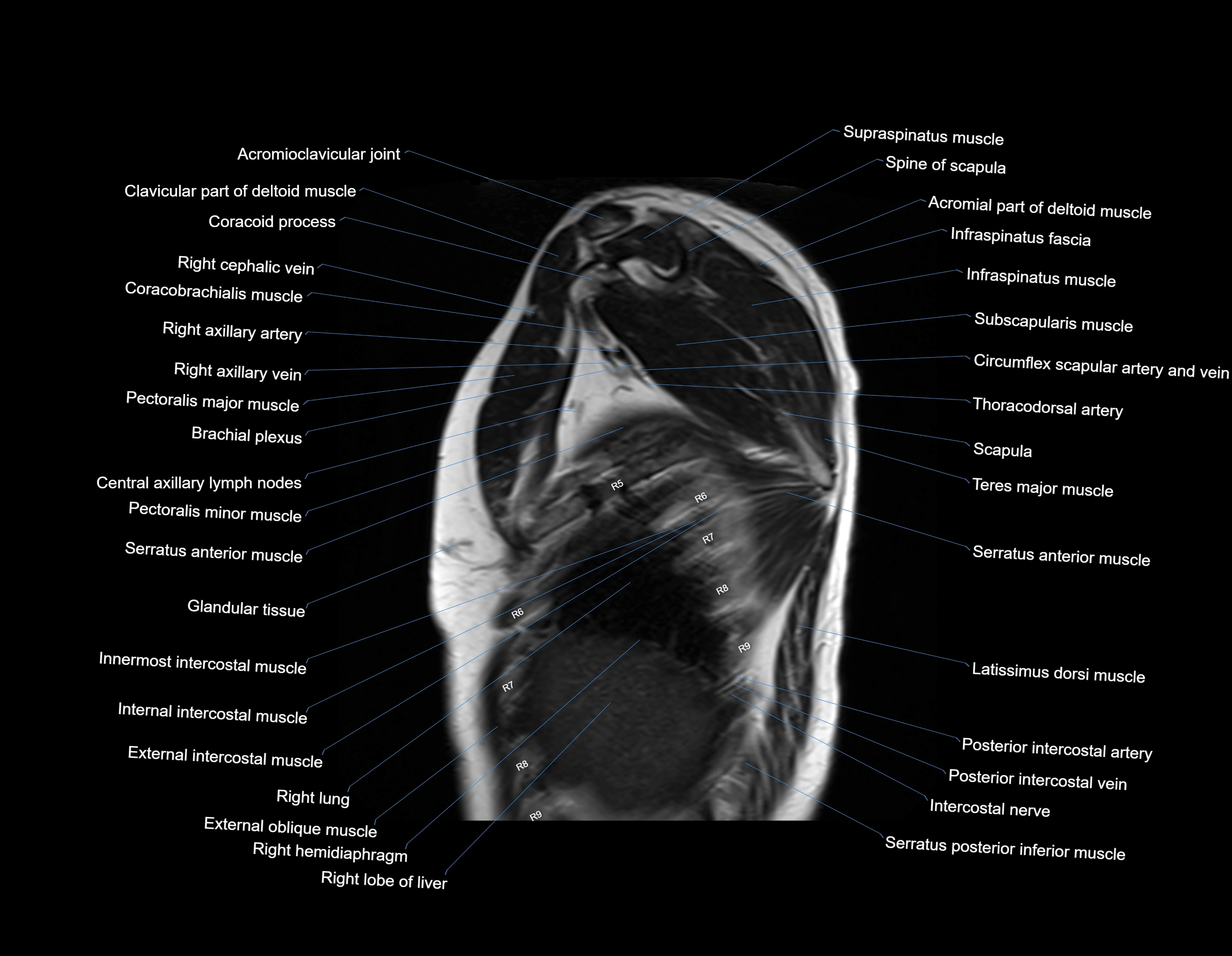 MRI chest (thorax) sagittal labelled cross sectional anatomy 3T radiology image-img-00001-00005.webp